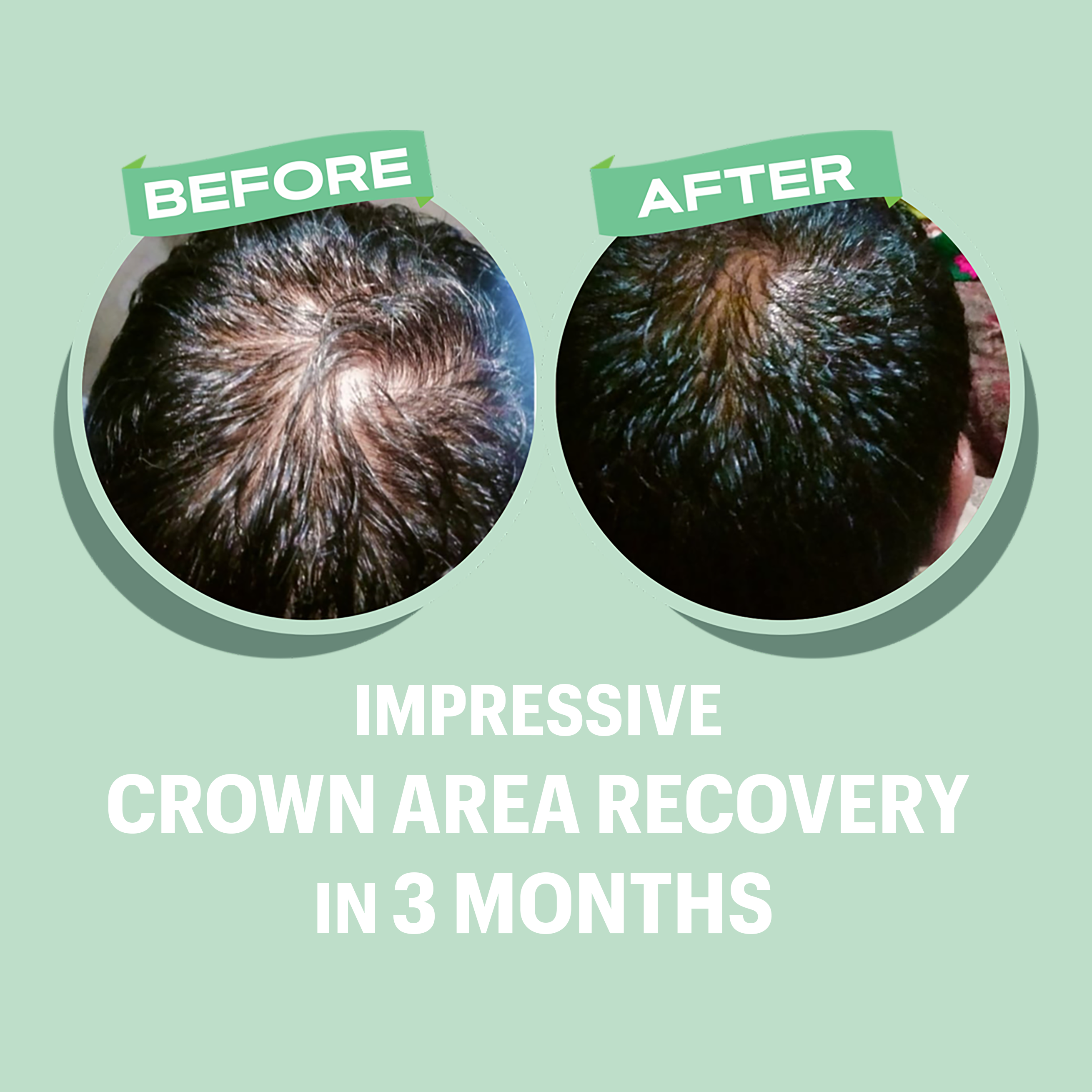 Croda Procapila Anti Hair Loss And Hair Growth Serum - Nutrex Labs