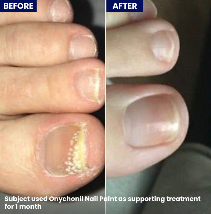 Onychonil Nail Paint - Jenpharm