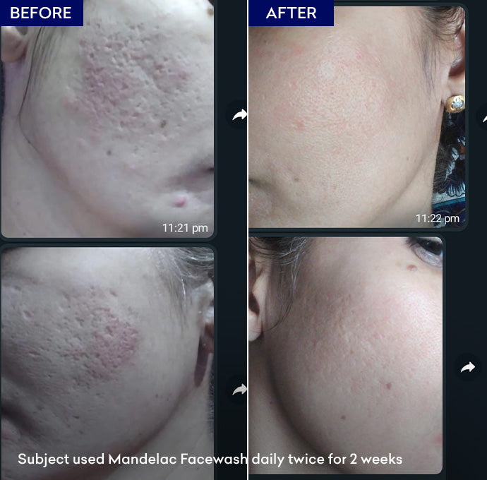 MandelAC Facewash 100ml - Jenpharm