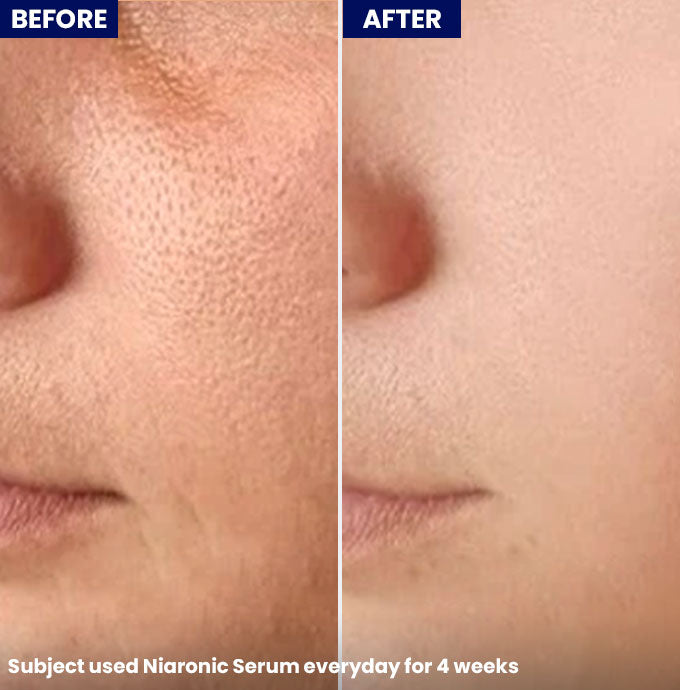 NiaRonic Serum (Pore Minimizing) 30ml - Jenpharm