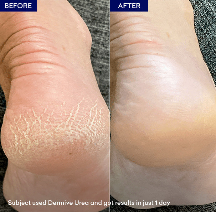 Dermive Urea Moisturizer 100ml - Jenpharm